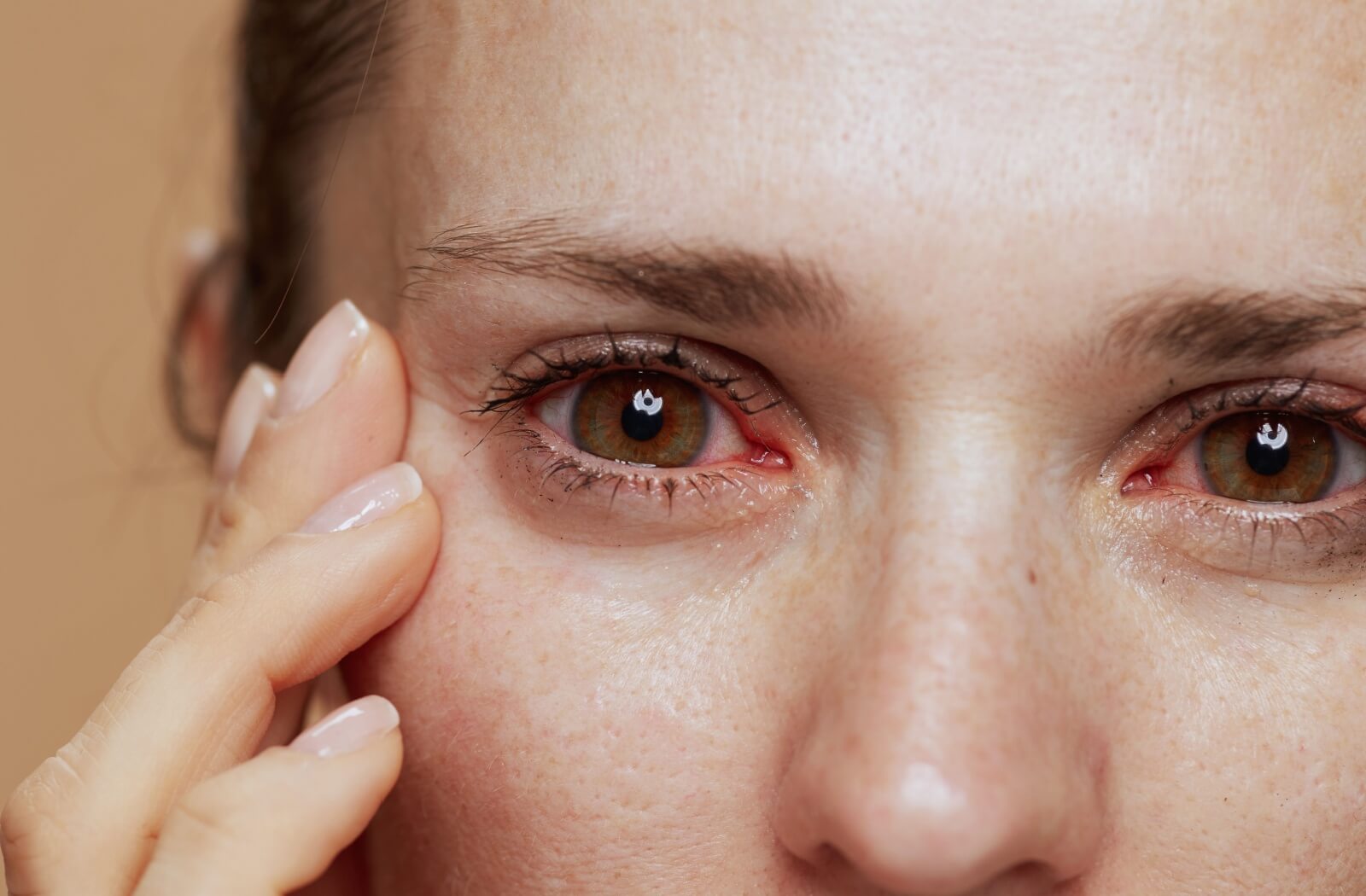 A close-up of a person’s inflamed, red eyes, showing visible irritation and dryness, indicative of dry eye syndrome.