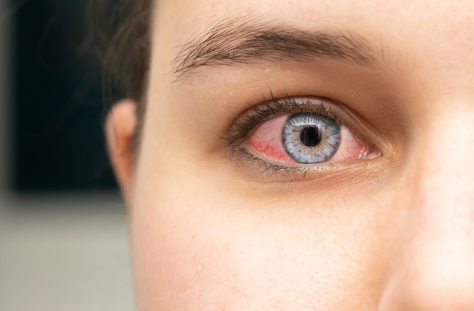 Close-up of an eye with noticeable redness in the white part, indicating irritation or possible infection. The person’s pupil is dilated, and the surrounding skin appears slightly inflamed.