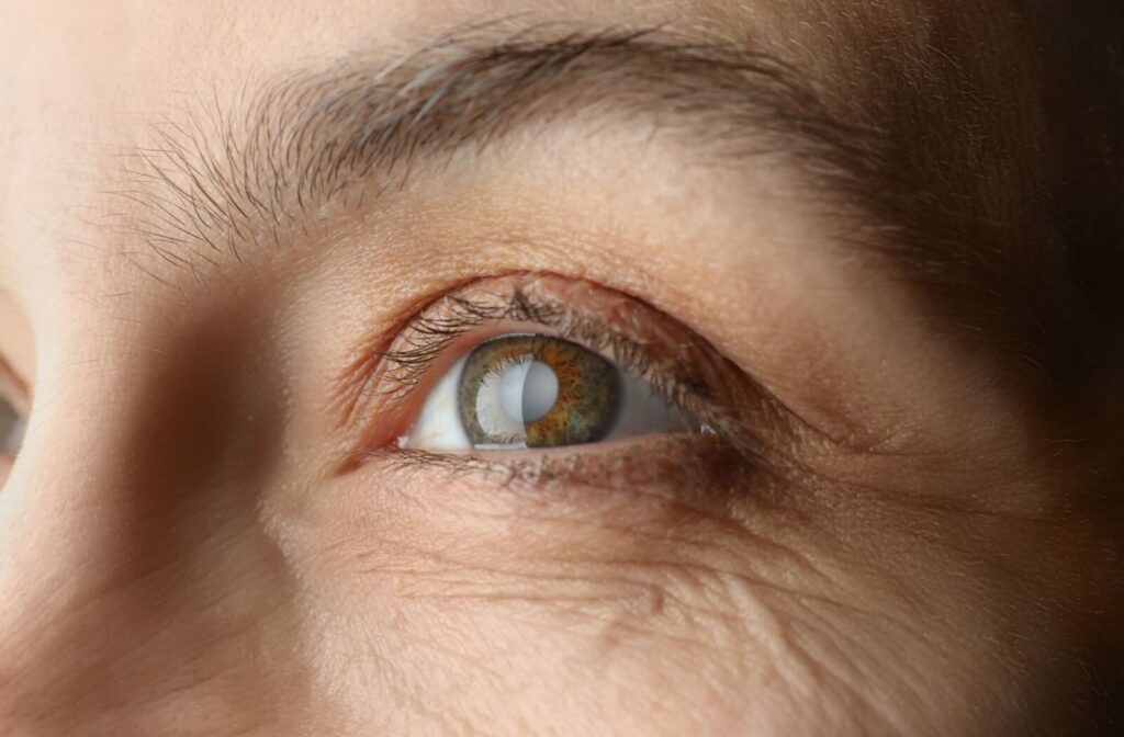 An image of an older adult's eye with a cataract developing and causing it to appear cloudy.