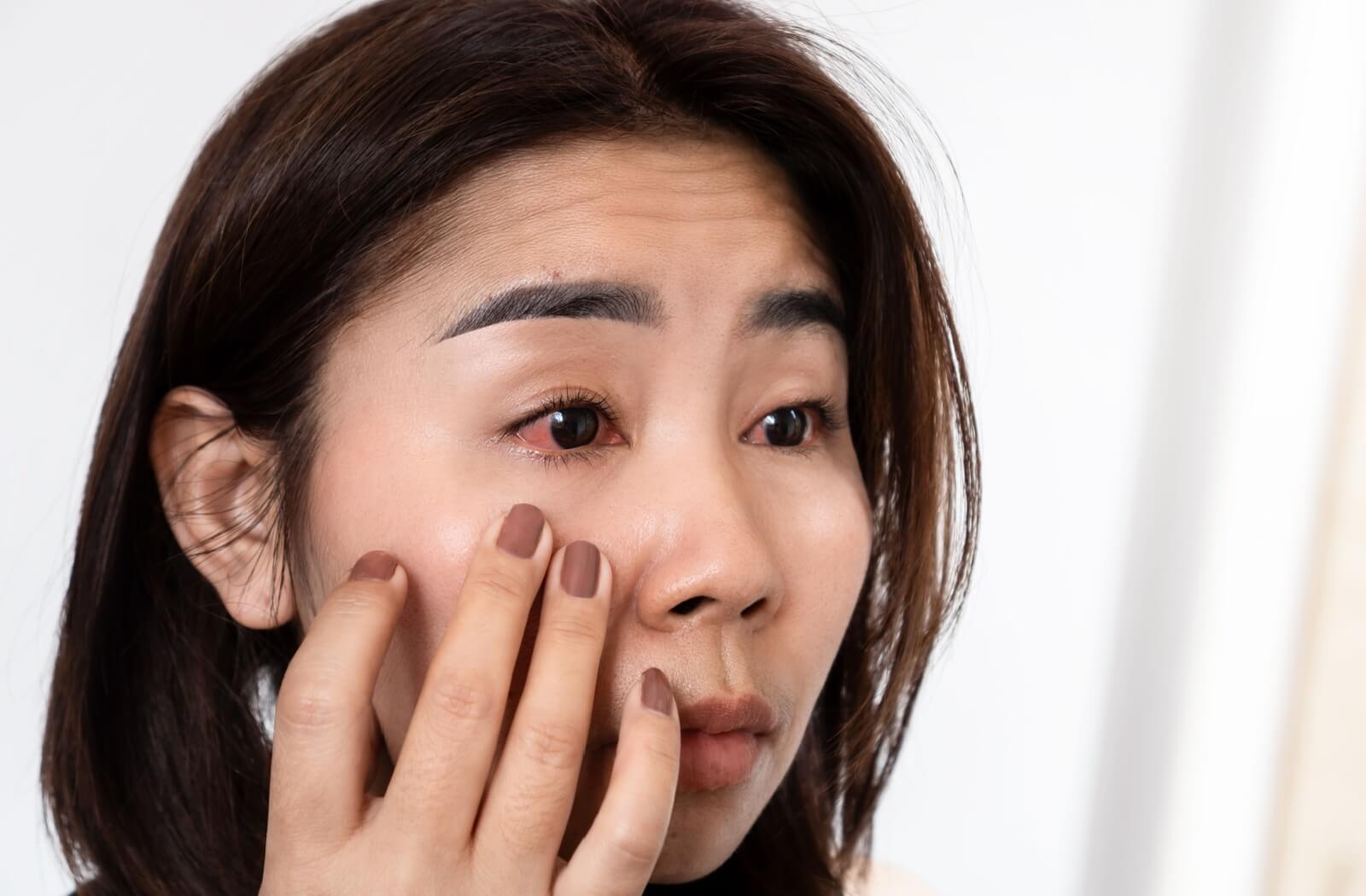 A person with irritated, red eyes gently touching the skin beneath one eye while looking in the mirror.
