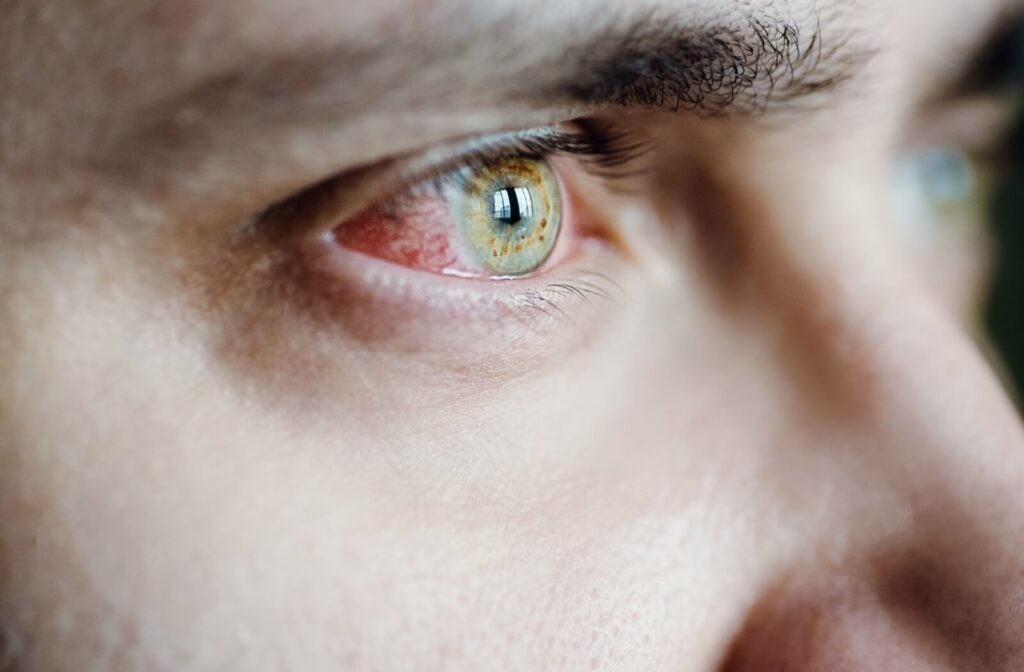 A close-up of an eye with visible redness in the inner corner and along the lower eyelid, showing irritation against the surrounding skin.